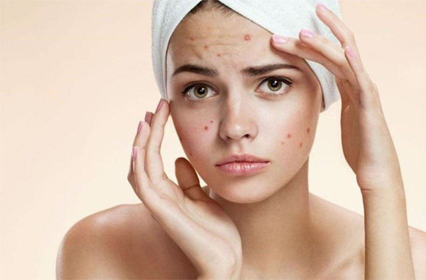 piel con acne necesita specilalistas en Láser fraccional no ablativo