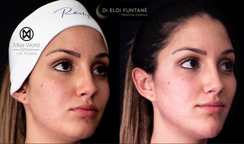 mujer de perfil antes y despues de un tratamiento de la mandibula clinicas esteticas eloi funtane canarias