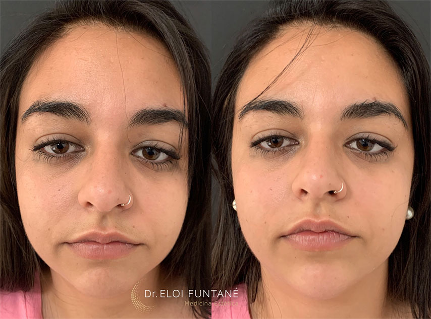 mujer joven de cara antes y despues de tratamiento menton clinicas esteticas eloi funtane canarias