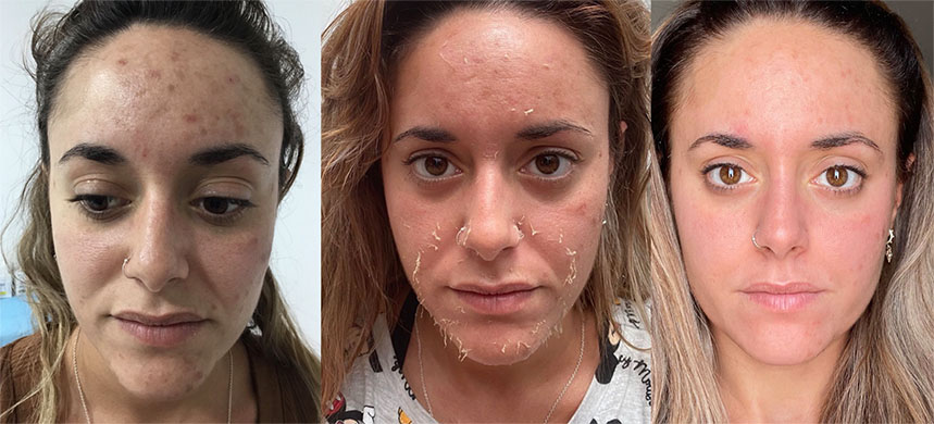 mujer de cara antes durante y despues de un peeling facial en clinicas esteticas eloi funtane canarias