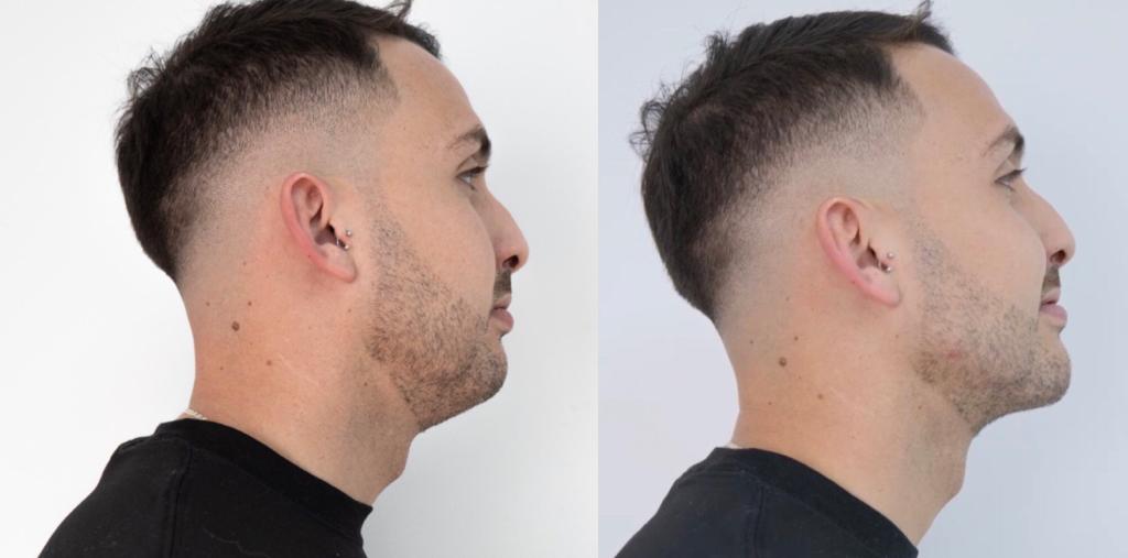 hombre de perfil antes y despues de un tratamiento de la mandibula en clnicas esteticas eloi funtane canarias