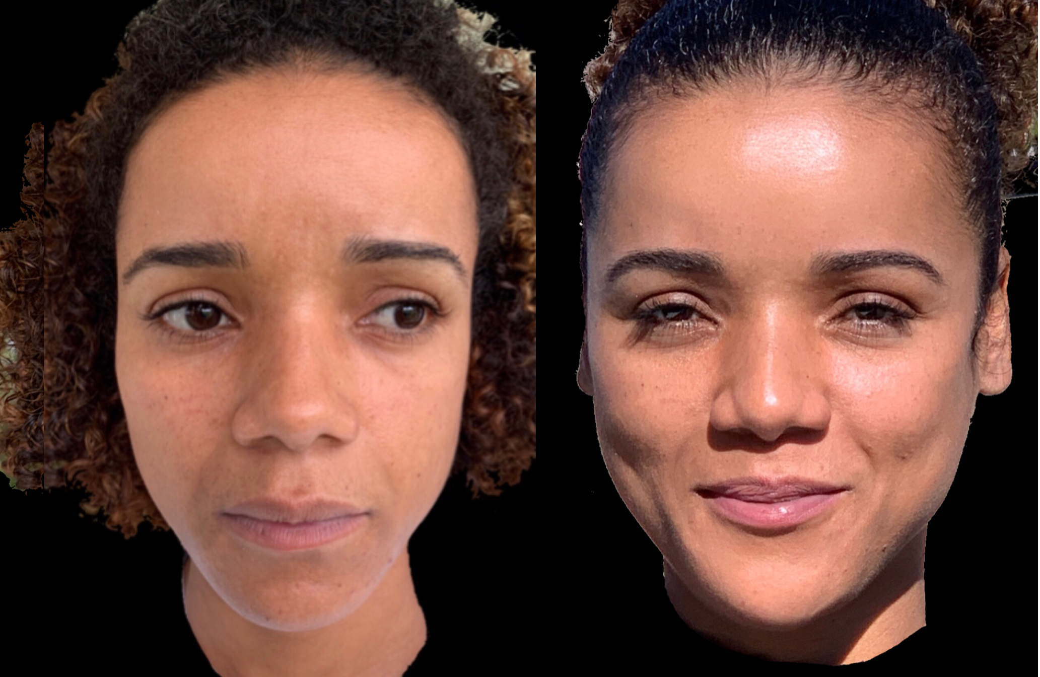 Mujer joven antes y después tratamiento full face