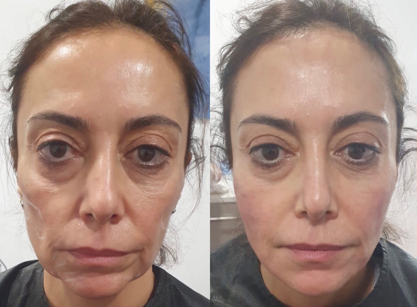 mujer antes y despues de un tratamiento fullface en clinicas eloi funtane Canarias